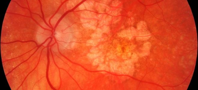 Виды заболеваний сетчатки глаза и лечение