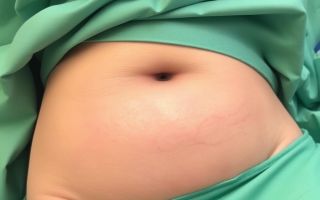 Удаление комков Биша: как сделать скулы выразительнее