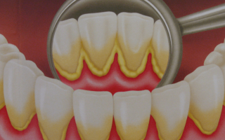Лечение зубного камня: неотъемлемая часть здоровья рта