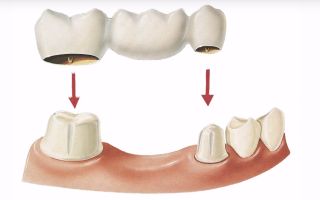 Компоненты протезирования зубов