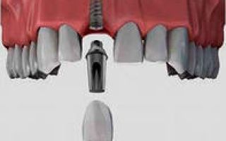 Как вставить зуб-имплант: все, что нужно знать о протезировании