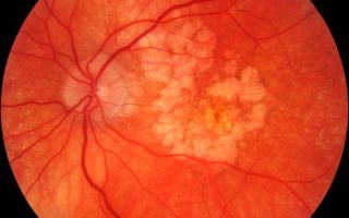 Виды заболеваний сетчатки глаза и лечение